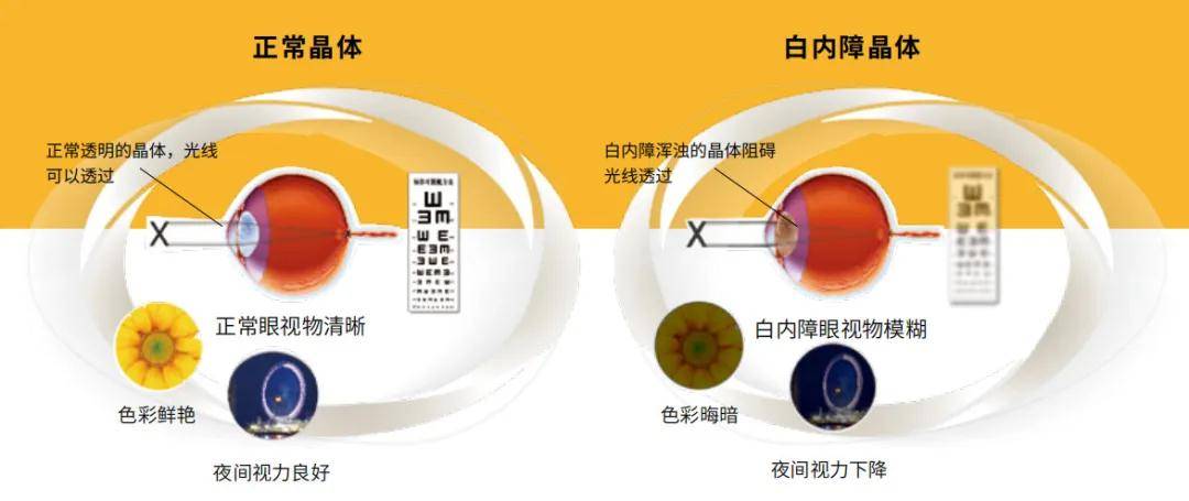玻璃體混濁最新特效藥，突破與創(chuàng)新的治療策略